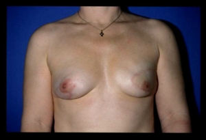 Ergebnis einer Brust Op nach brustkrebs