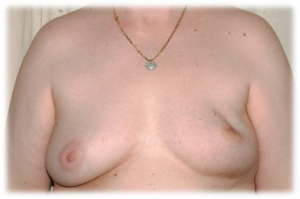 Bild einer Patientin mit Brustkrebs die sich eine Brustrekonstruktion wünscht.