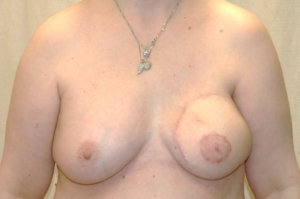 Ergebnis eines Brust Aufbau nach Brustkrebs.