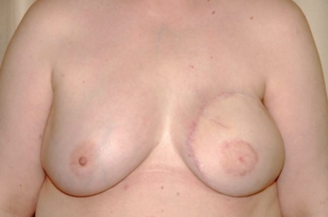 Die gesunde rechte Brust wurde an die Rekonstruierte durch einsetzen eines kleinen Implantats an die linke Seite angegleicht.