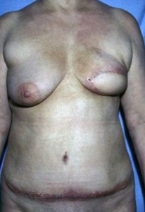 Zustand nach der Entfernung der linken Brust und Sofort Rekonstruktion.
