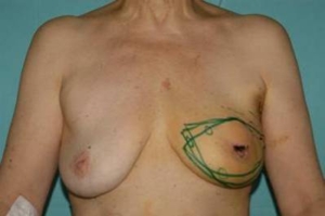 Aufgrund von Brustkrebs wird die linke Seite entfernt sowie sofort mittels Eigengewebe rekonstruiert.