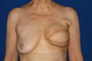 Zustand nach der Entfernung und sofortigen Rekonstruktion der Brust nach Brustkrebs.