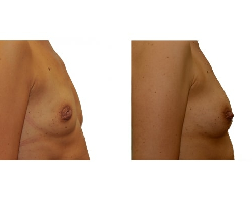 Vorher Nachher Fotos einer Brustvergrößerung mit Eigenfett