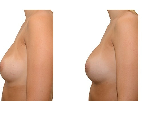 Ergebnis nach 3 Brustvergrößerungen mit Eigenfett und PRP Anreicherung