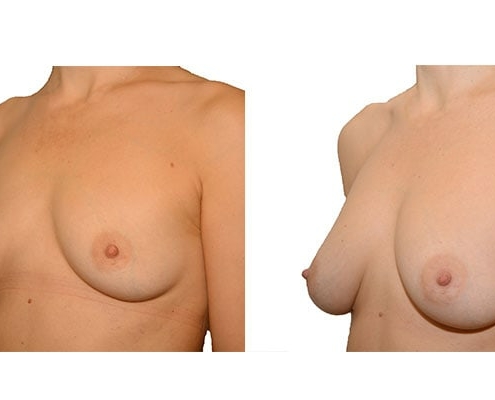 Ergebnis nach 4 Brustvergrößerungen mit Eigenfett und PRP Anreicherung