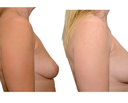 Ergebnis von natürlicher Brustvergrößerung nach 2 Eigenfetttransplantationen.