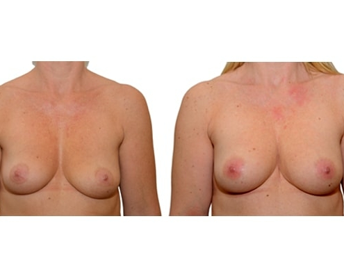 Ergebnis einer Brustvergroesserung nach 2 Eigenfetttransplantationen.