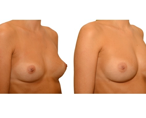 Brustvergroesserung nach 3 Eigenfetttransplantationen 1b
