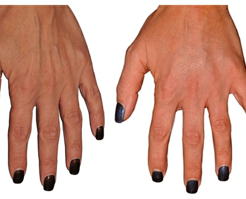 Ergebnis schöner, glatter Hände durch Eigenfetttransplantation an den Händen.