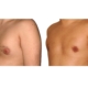 Ursprüngliche Brust und Ergebnis nach der Gynäkomastie Operation.