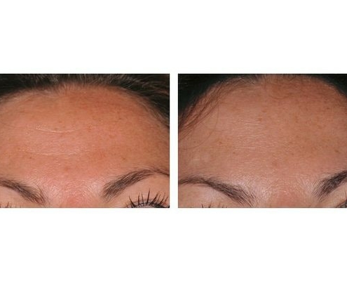 Botox zur Behandlung von Stirnfalten