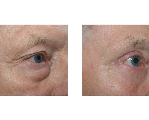 Vorher Nachher einer Korrektur von Tränensäcken und Schlupflidern mit anschließender Augenbrauenhebung
