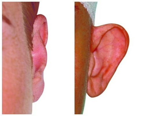 Korrektur eines abstehendes Ohr aufgrund eines stumpfen Anthelixwinkels und zu breiter Concha