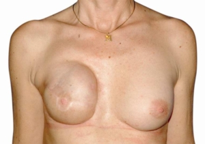 Die Rekonstruktion der Brust erfolgte mittles Silikonimplantat und Deckung mit Hautmuseklappenplastik vom Rücken (Latissimus).