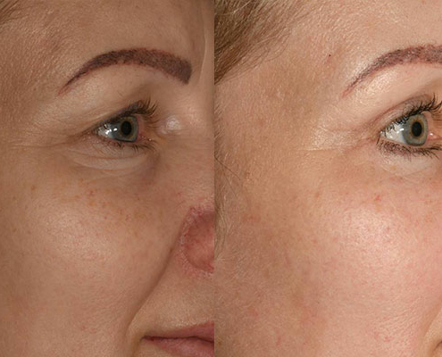 Beispiel vor und nach einer Augenlidstraffung, Brauenlifting, Faceliftung und Eigenfetttransplantation.