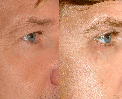 Beispiel eines Patienten mit mehreren Eingriffen im Gesicht: Augenlidstraffung, Brauenlifting, Faceliftung und Eigenfetttransplantation