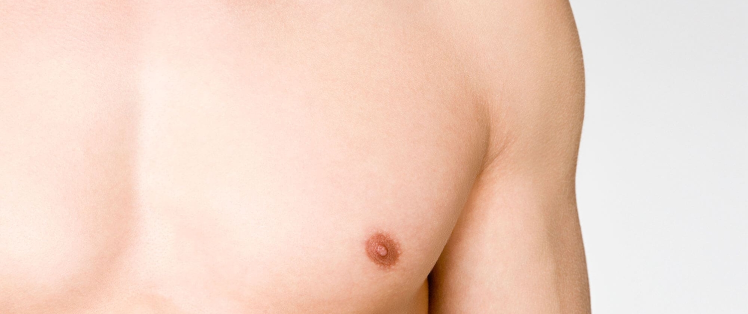 Gynecomastia - Wikipedia